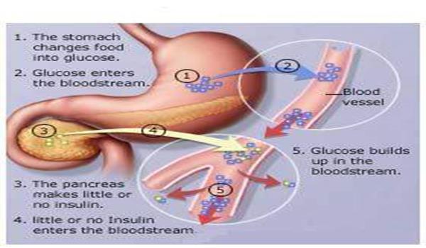 Diabetes tipo 1 produce cetosis